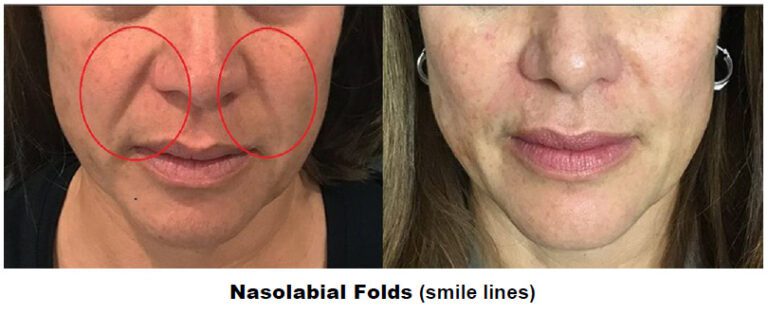 PDO on nasolabial folds