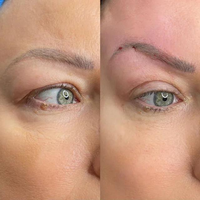 PDO thread lift on eyes