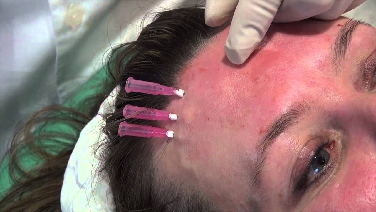 forehead lifting