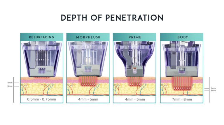 how does Morpheus8 works Los Angeles