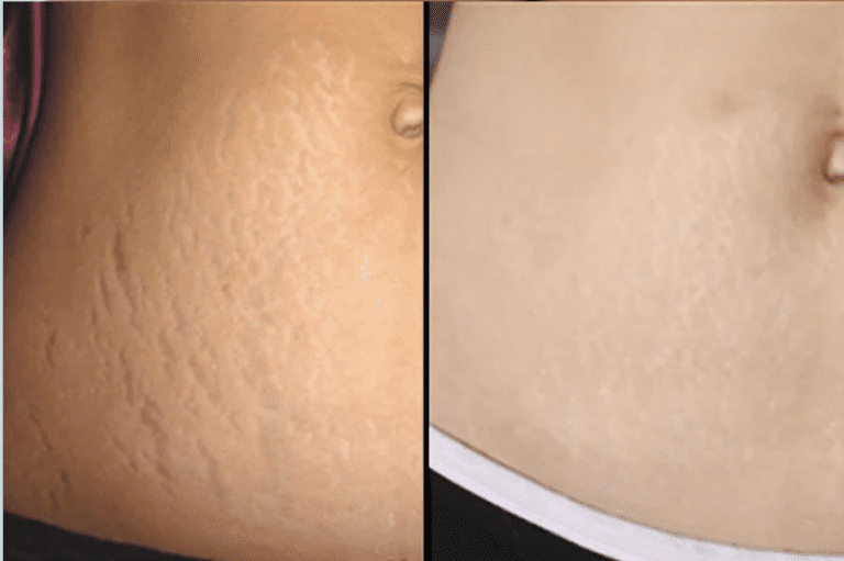 stretch mark removal with Morpheus 8 treatment on belly before and after