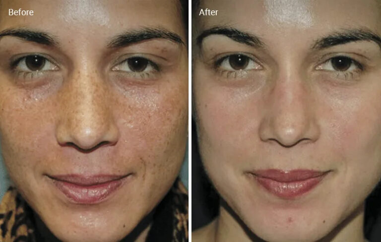 Chemical peel treatment before-after Los Angeles