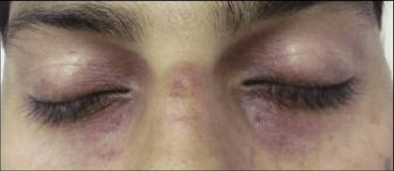 Hyperpigmentation of the eyelids