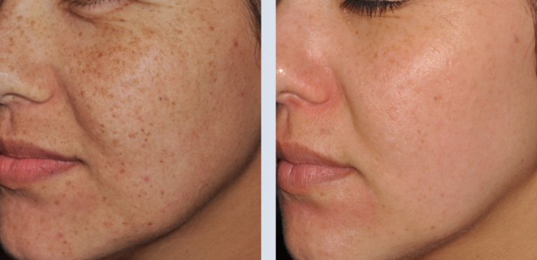 Lumecca IPL before-after freckles Los Angeles