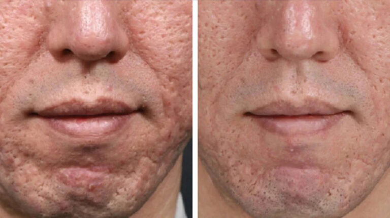 Microneedling for acne scars