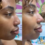 PDO Nose Threads treatment Los Angeles