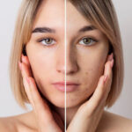 acne scars treatment with microneedling
