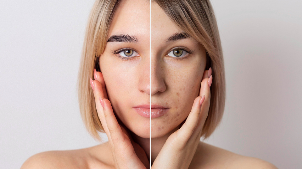 acne scars treatment with microneedling