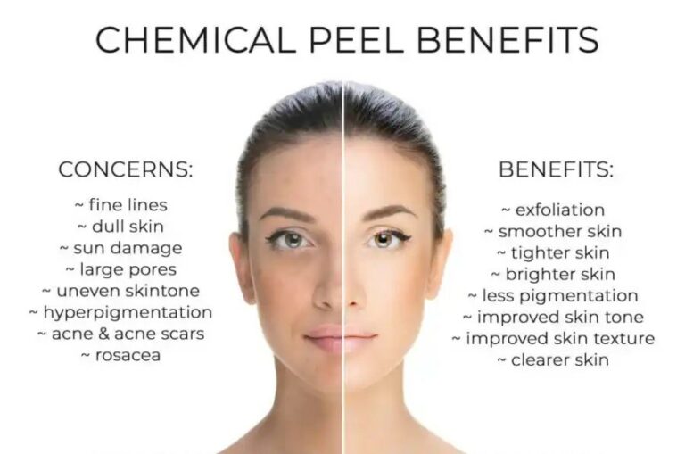 the benefits of chemical peel Los Angeles