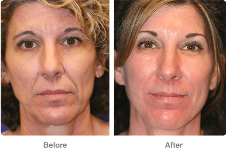 get rid of wrinkles with a vampire facelift in Los Angeles. Before and after results