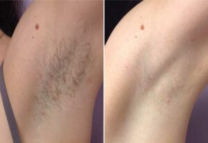 Laser hair removal underarms