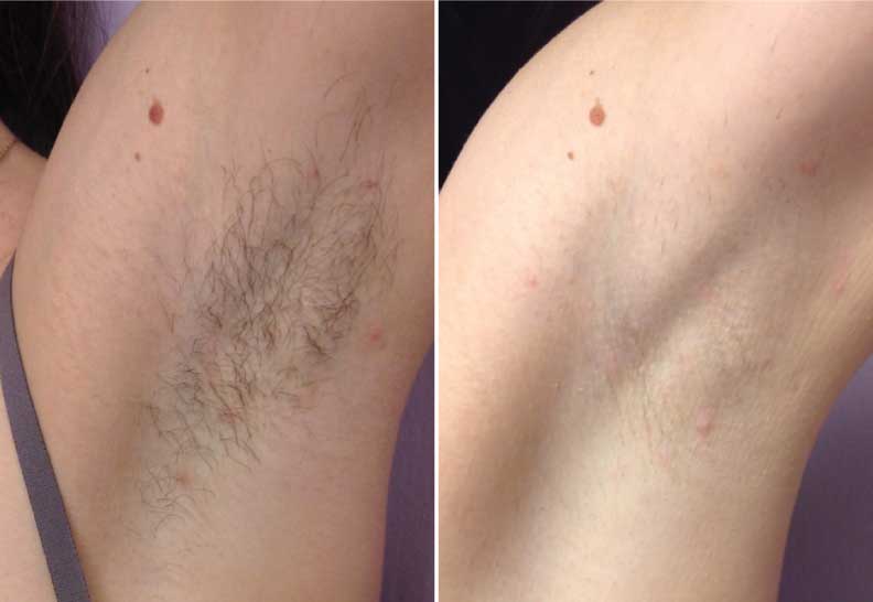 armpits laser hair removal before-after