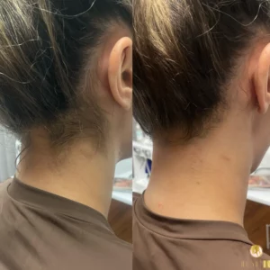 laser hair removal on the neck