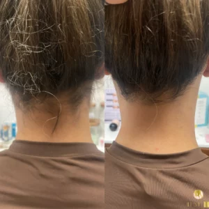 laser hair removal on woman's neck