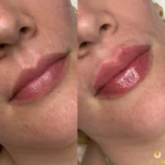 lip augmentation in Los Angeles