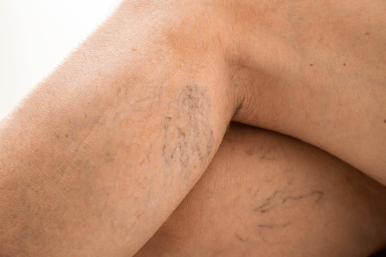 no laser hair removal for varicose vein