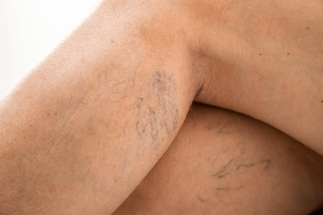 no laser hair removal for varicose vein