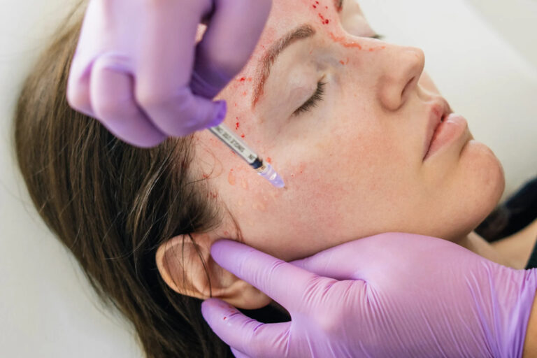woman getting PRP treatment