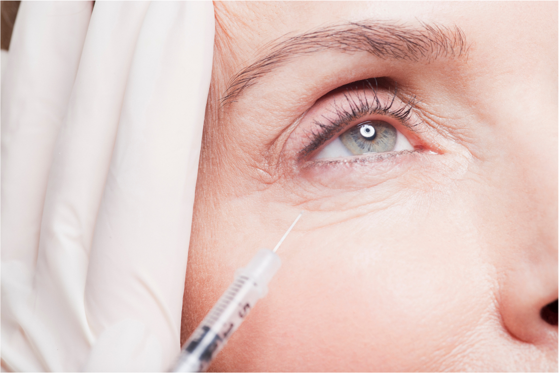 Botox is a quick and painless cosmetic solution for wrinkles around the eyes