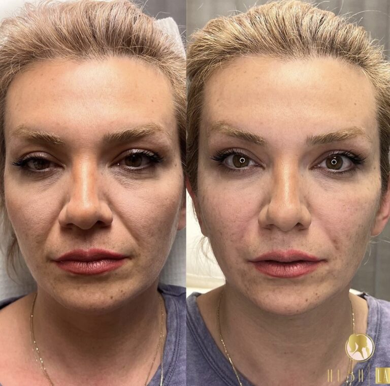 Botox for marionette lines