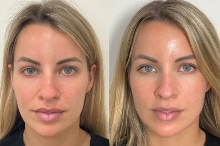 sculptra before-after