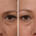 Dysport Botox aesthetic solution Los Angeles