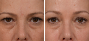 Dysport Botox aesthetic solution Los Angeles