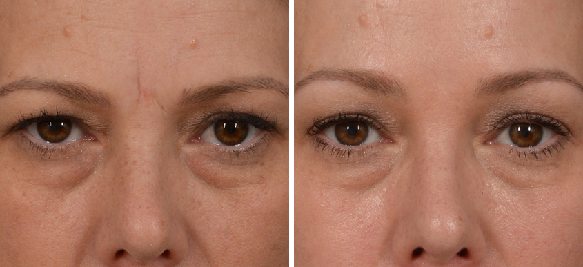 Dysport Botox aesthetic solution Los Angeles