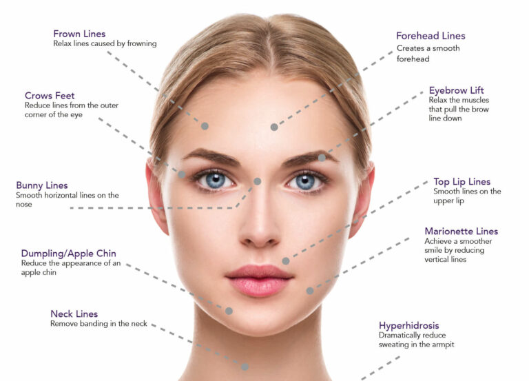 Dysport and Botox injectable areas Los Angeles