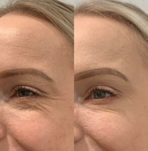 botox dysport before-after Los Angeles