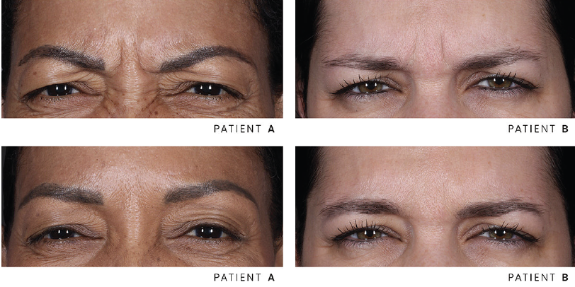 daxxify injection before-after Los Angeles