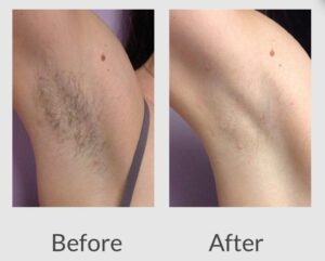 laser-hair-removal-before-after Los Angeles