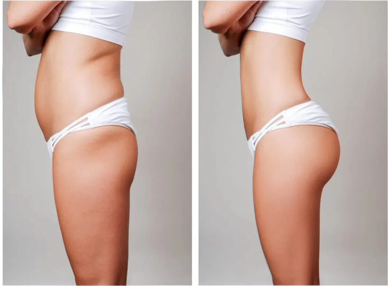 Sculptra non-surgical butt lift - Hush LA Medspa