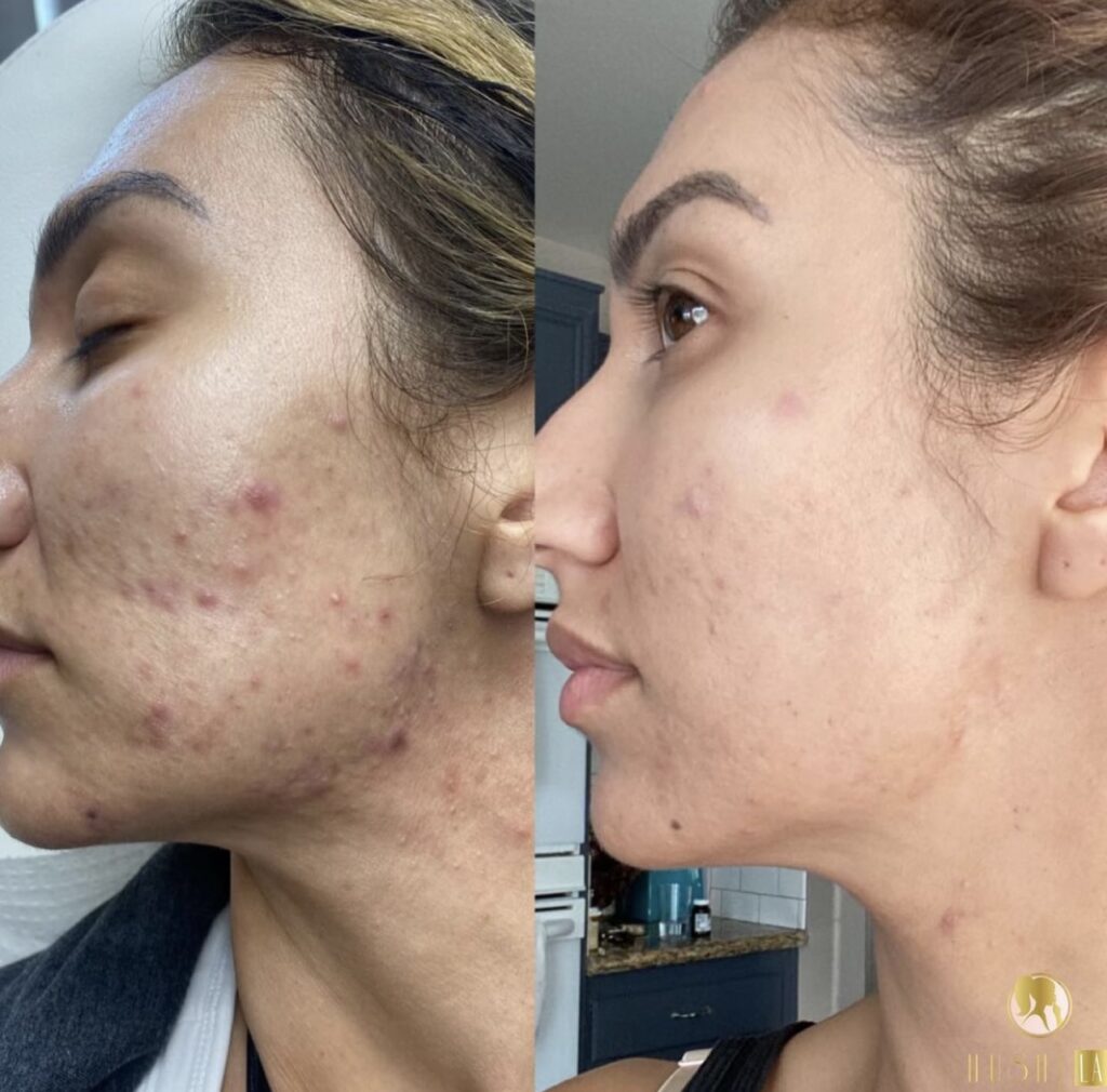 Acne treatment via Morpheus 8