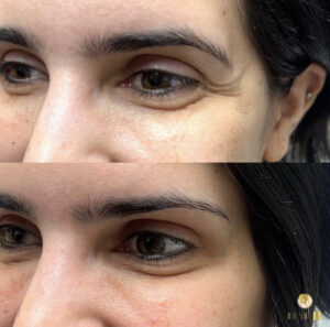 Botox filler for Crow's feet