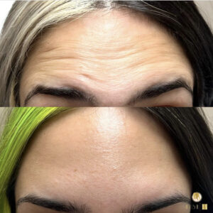 Botox filler for forhead in Los Angeles