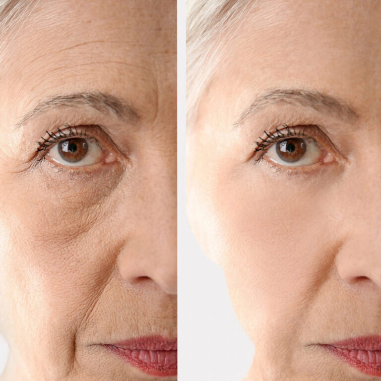 Dermal fillers for face treatment before-after Los Angeles