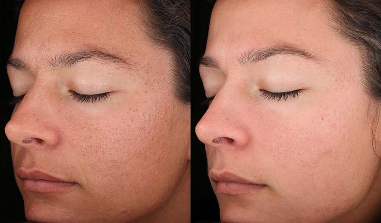DiamondGlow for uneven skin tone before-after