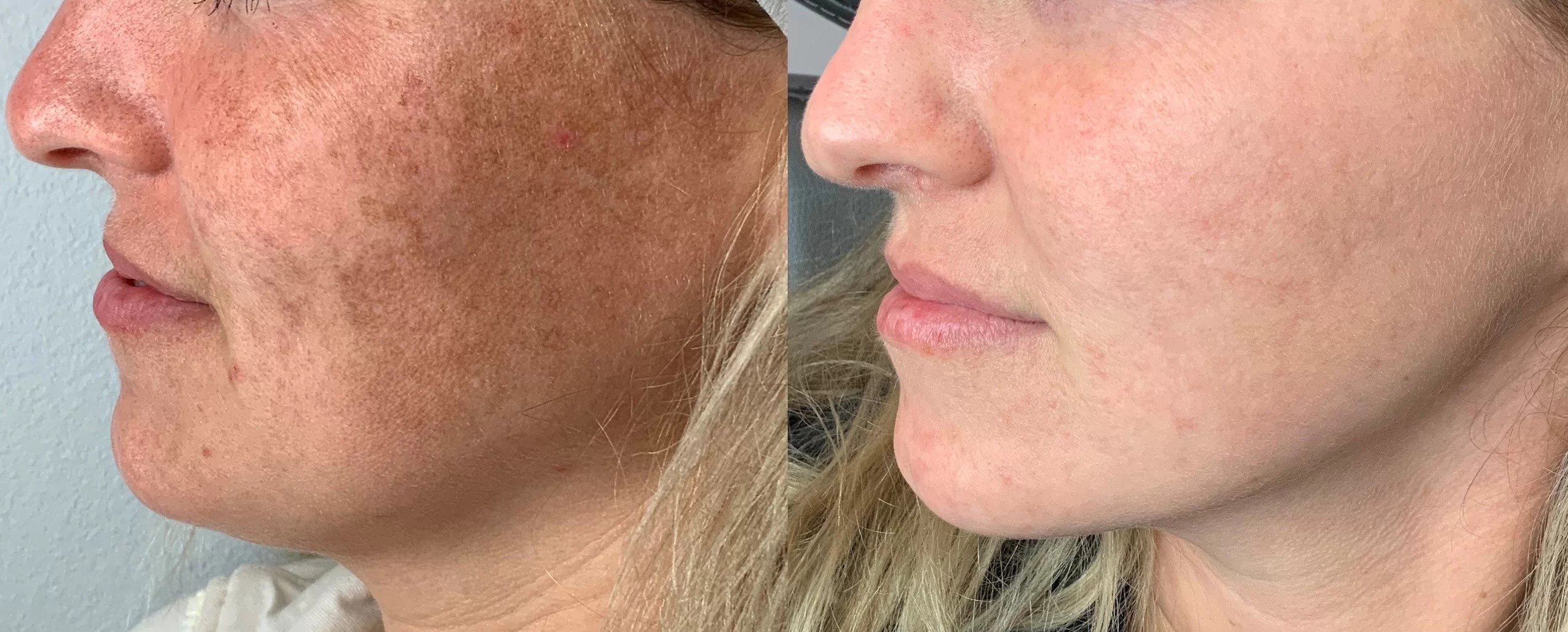 Lumecca IPL skin tone treatment