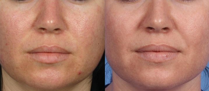 Microneedling facial before-after