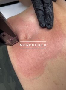 Morpheus 8 treatment on abdomen Los Angeles