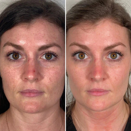 Morpheus8 treatment before-after