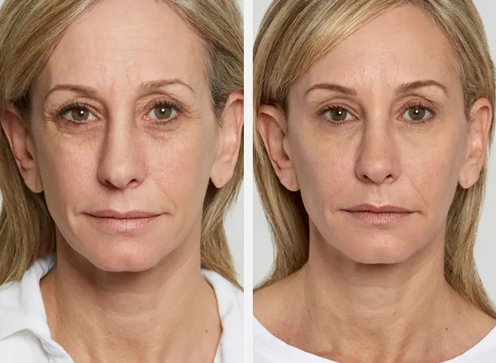 Sculptra Filler for cheek wrinkles Before-After Los Angeles