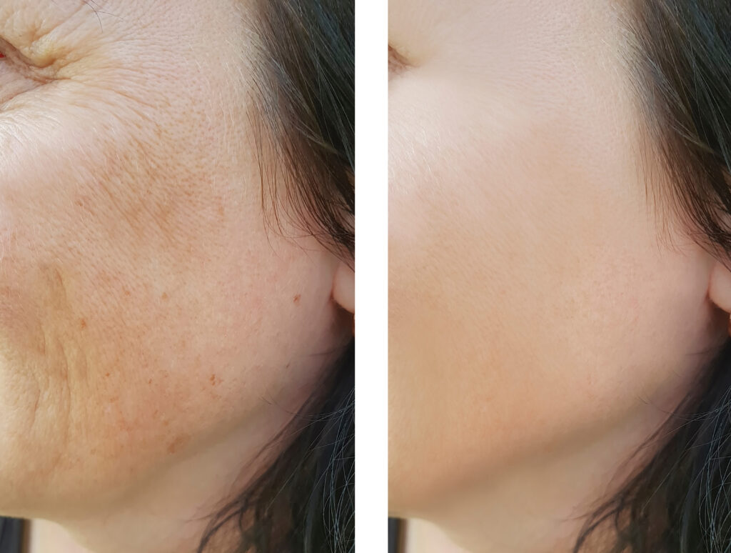 chemical peel facial for uneven skin tone