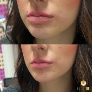 chin fillers Los Angeles