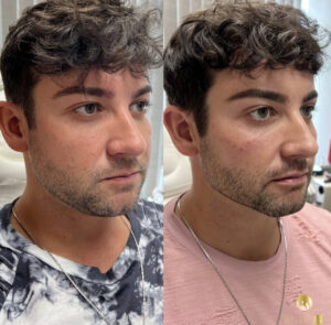 facial structuring with fillers in Los Angeles
