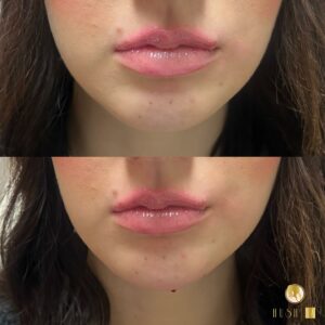 fillers for chin in Los Angeles