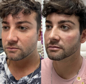 jawline contouring in Los Angeles