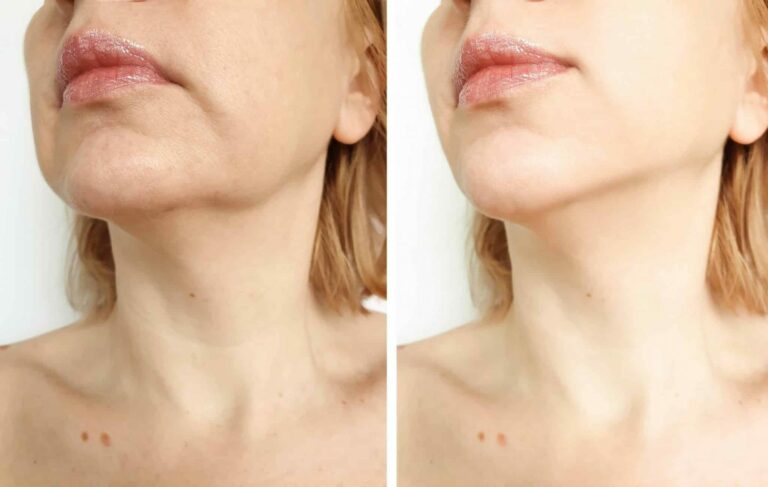 microneedling for sagging skin treatment Los Angeles