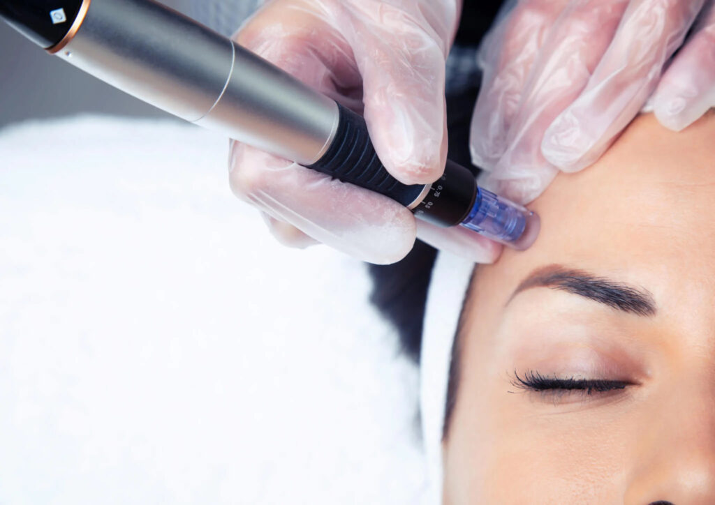 microneedling for summer facial Los Angeles